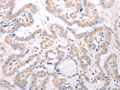 The image on the left is immunohistochemistry of paraffin-embedded Human thyroid cancer tissue using CSB-PA552167(CIDEB Antibody) at dilution 1/50, on the right is treated with fusion protein. (Original magnification: ×200)