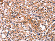 The image on the left is immunohistochemistry of paraffin-embedded Human thyroid cancer tissue using CSB-PA552207(BCR Antibody) at dilution 1/15, on the right is treated with synthetic peptide. (Original magnification: ×200)