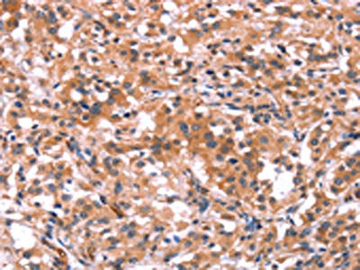 The image on the left is immunohistochemistry of paraffin-embedded Human thyroid cancer tissue using CSB-PA552207(BCR Antibody) at dilution 1/15, on the right is treated with synthetic peptide. (Original magnification: ×200)