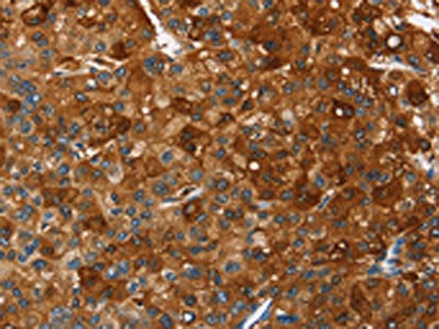 The image on the left is immunohistochemistry of paraffin-embedded Human liver cancer tissue using CSB-PA552213(PAK2 Antibody) at dilution 1/40, on the right is treated with fusion protein. (Original magnification: ×200)