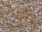 The image on the left is immunohistochemistry of paraffin-embedded Human breast cancer tissue using CSB-PA552215(GCK Antibody) at dilution 1/60, on the right is treated with fusion protein. (Original magnification: ×200)