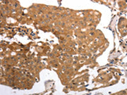 The image on the left is immunohistochemistry of paraffin-embedded Human breast cancer tissue using CSB-PA552248(MMP27 Antibody) at dilution 1/40, on the right is treated with synthetic peptide. (Original magnification: ×200)