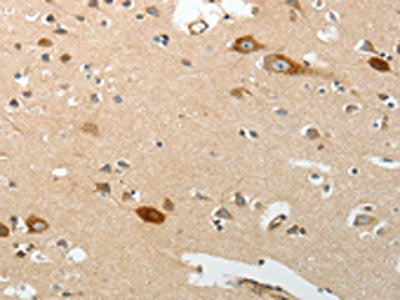 The image on the left is immunohistochemistry of paraffin-embedded Human brain tissue using CSB-PA552311(SREBF2 Antibody) at dilution 1/30, on the right is treated with synthetic peptide. (Original magnification: ×200)