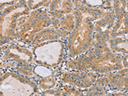 The image on the left is immunohistochemistry of paraffin-embedded Human thyroid cancer tissue using CSB-PA552622(PTPN4 Antibody) at dilution 1/40, on the right is treated with synthetic peptide. (Original magnification: ×200)
