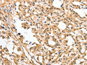 The image on the left is immunohistochemistry of paraffin-embedded Human thyroid cancer tissue using CSB-PA552720(APTX Antibody) at dilution 1/50, on the right is treated with fusion protein. (Original magnification: ×200)