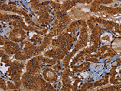 The image on the left is immunohistochemistry of paraffin-embedded Human thyroid cancer tissue using CSB-PA552938(WDR83 Antibody) at dilution 1/60, on the right is treated with fusion protein. (Original magnification: ×200)