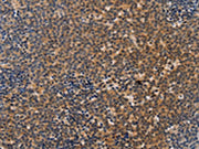The image on the left is immunohistochemistry of paraffin-embedded Human Lymphoma tissue using CSB-PA553079(NCR1 Antibody) at dilution 1/20, on the right is treated with synthetic peptide. (Original magnification: ×200)