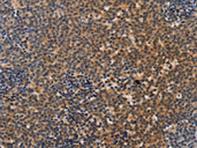 The image on the left is immunohistochemistry of paraffin-embedded Human Lymphoma tissue using CSB-PA553079(NCR1 Antibody) at dilution 1/20, on the right is treated with synthetic peptide. (Original magnification: ×200)