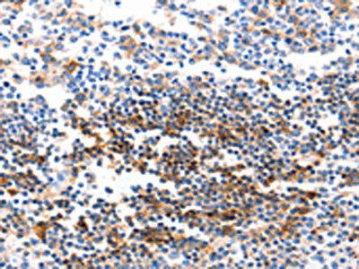 The image on the left is immunohistochemistry of paraffin-embedded Human tonsil tissue using CSB-PA553249(GJB6 Antibody) at dilution 1/40, on the right is treated with synthetic peptide. (Original magnification: ×200)