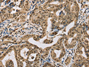The image on the left is immunohistochemistry of paraffin-embedded Human gastic cancer tissue using CSB-PA553324(CENPV Antibody) at dilution 1/30, on the right is treated with synthetic peptide. (Original magnification: ×200)