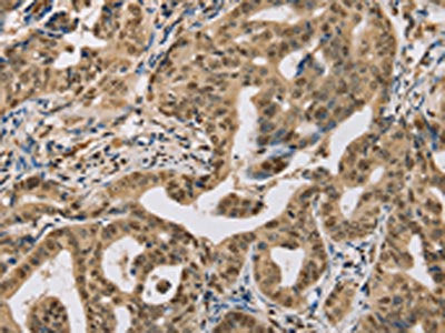 The image on the left is immunohistochemistry of paraffin-embedded Human gastic cancer tissue using CSB-PA553324(CENPV Antibody) at dilution 1/30, on the right is treated with synthetic peptide. (Original magnification: ×200)