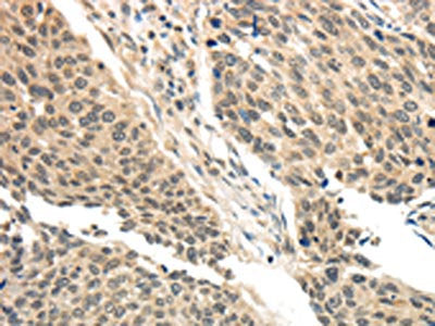 The image on the left is immunohistochemistry of paraffin-embedded Human lung cancer tissue using CSB-PA553405(BRCA2 Antibody) at dilution 1/35, on the right is treated with synthetic peptide. (Original magnification: ×200)