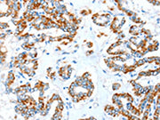The image on the left is immunohistochemistry of paraffin-embedded Human thyroid cancer tissue using CSB-PA553471(ALDH5A1 Antibody) at dilution 1/35, on the right is treated with synthetic peptide. (Original magnification: ×200)
