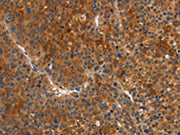 The image on the left is immunohistochemistry of paraffin-embedded Human liver cancer tissue using CSB-PA553472(MAPK15 Antibody) at dilution 1/15, on the right is treated with fusion protein. (Original magnification: ×200)