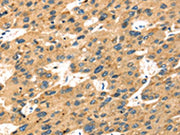 The image on the left is immunohistochemistry of paraffin-embedded Human liver cancer tissue using CSB-PA553505(SEPP1 Antibody) at dilution 1/20, on the right is treated with fusion protein. (Original magnification: ×200)
