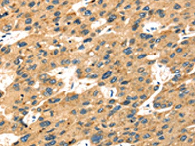 The image on the left is immunohistochemistry of paraffin-embedded Human liver cancer tissue using CSB-PA553505(SEPP1 Antibody) at dilution 1/20, on the right is treated with fusion protein. (Original magnification: ×200)
