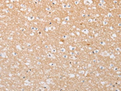 The image on the left is immunohistochemistry of paraffin-embedded Human brain tissue using CSB-PA554014(ATG9A Antibody) at dilution 1/30, on the right is treated with fusion protein. (Original magnification: ×200)