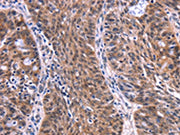 The image on the left is immunohistochemistry of paraffin-embedded Human ovarian cancer tissue using CSB-PA554018(EIF2AK4 Antibody) at dilution 1/50, on the right is treated with fusion protein. (Original magnification: ×200)