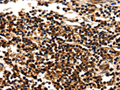 The image on the left is immunohistochemistry of paraffin-embedded Human liver cancer tissue using CSB-PA554071(MYOZ1 Antibody) at dilution 1/25, on the right is treated with fusion protein. (Original magnification: ×200)