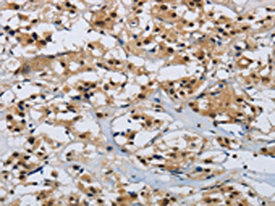 The image on the left is immunohistochemistry of paraffin-embedded Human thyroid cancer tissue using CSB-PA554166(CMTM8 Antibody) at dilution 1/40, on the right is treated with synthetic peptide. (Original magnification: ×200)
