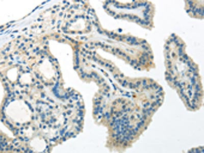 The image on the left is immunohistochemistry of paraffin-embedded Human thyroid cancer tissue using CSB-PA554204(WNT10A Antibody) at dilution 1/30, on the right is treated with synthetic peptide. (Original magnification: ×200)