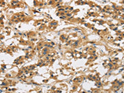 The image is immunohistochemistry of paraffin-embedded Human thyroid cancer tissue using CSB-PA554215(GAS7 Antibody) at dilution 1/50. (Original magnification: ×200)