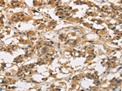 The image is immunohistochemistry of paraffin-embedded Human thyroid cancer tissue using CSB-PA554215(GAS7 Antibody) at dilution 1/50. (Original magnification: ×200)
