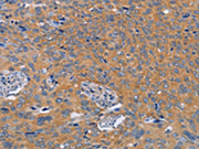 The image on the left is immunohistochemistry of paraffin-embedded Human cervical cancer tissue using CSB-PA554403(BOD1 Antibody) at dilution 1/60, on the right is treated with synthetic peptide. (Original magnification: ×200)