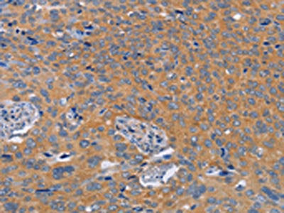 The image on the left is immunohistochemistry of paraffin-embedded Human cervical cancer tissue using CSB-PA554403(BOD1 Antibody) at dilution 1/60, on the right is treated with synthetic peptide. (Original magnification: ×200)