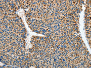 The image on the left is immunohistochemistry of paraffin-embedded Human liver cancer tissue using CSB-PA554520(RCAN1 Antibody) at dilution 1/45, on the right is treated with synthetic peptide. (Original magnification: ×200)