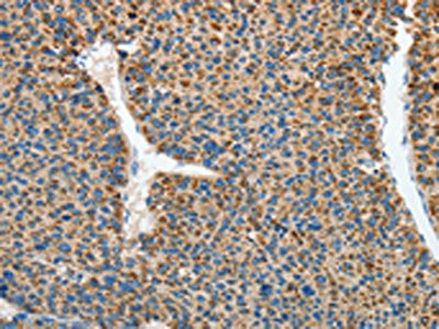 The image on the left is immunohistochemistry of paraffin-embedded Human liver cancer tissue using CSB-PA554520(RCAN1 Antibody) at dilution 1/45, on the right is treated with synthetic peptide. (Original magnification: ×200)