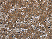 The image on the left is immunohistochemistry of paraffin-embedded Human liver cancer tissue using CSB-PA554723(GABRB1 Antibody) at dilution 1/50, on the right is treated with fusion protein. (Original magnification: ×200)