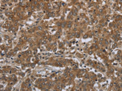 The image on the left is immunohistochemistry of paraffin-embedded Human liver cancer tissue using CSB-PA554723(GABRB1 Antibody) at dilution 1/50, on the right is treated with fusion protein. (Original magnification: ×200)
