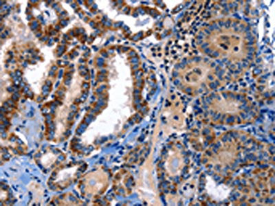 The image on the left is immunohistochemistry of paraffin-embedded Human thyroid cancer tissue using CSB-PA554957(STAT5A Antibody) at dilution 1/25, on the right is treated with fusion protein. (Original magnification: ×200)