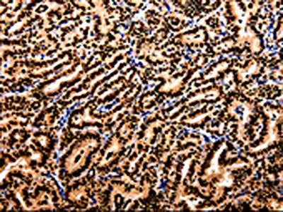 The image on the left is immunohistochemistry of paraffin-embedded Human thyroid cancer tissue using CSB-PA555100(APIP Antibody) at dilution 1/10, on the right is treated with fusion protein. (Original magnification: ×200)