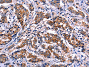 The image on the left is immunohistochemistry of paraffin-embedded Human breast cancer tissue using CSB-PA555295(EIF2AK4 Antibody) at dilution 1/50, on the right is treated with fusion protein. (Original magnification: ×200)