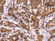 The image on the left is immunohistochemistry of paraffin-embedded Human breast cancer tissue using CSB-PA555338(CARD11 Antibody) at dilution 1/40, on the right is treated with fusion protein. (Original magnification: ×200)
