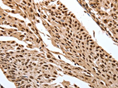 The image on the left is immunohistochemistry of paraffin-embedded Human cervical cancer tissue using CSB-PA555646(SRF Antibody) at dilution 1/30, on the right is treated with synthetic peptide. (Original magnification: ×200)