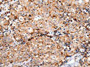 The image on the left is immunohistochemistry of paraffin-embedded Human breast cancer tissue using CSB-PA555678(MUC1(CT) Antibody) at dilution 1/20, on the right is treated with synthetic peptide. (Original magnification: ×200)