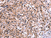 The image on the left is immunohistochemistry of paraffin-embedded Human esophagus cancer tissue using CSB-PA555803(AMIGO2 Antibody) at dilution 1/50, on the right is treated with fusion protein. (Original magnification: ×200)