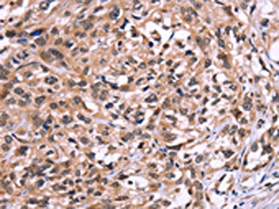 The image on the left is immunohistochemistry of paraffin-embedded Human esophagus cancer tissue using CSB-PA555803(AMIGO2 Antibody) at dilution 1/50, on the right is treated with fusion protein. (Original magnification: ×200)