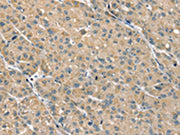 The image on the left is immunohistochemistry of paraffin-embedded Human liver cancer tissue using CSB-PA555844(PHLPP1 Antibody) at dilution 1/35, on the right is treated with fusion protein. (Original magnification: ×200)