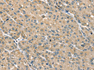 The image on the left is immunohistochemistry of paraffin-embedded Human liver cancer tissue using CSB-PA555844(PHLPP1 Antibody) at dilution 1/35, on the right is treated with fusion protein. (Original magnification: ×200)