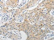 The image on the left is immunohistochemistry of paraffin-embedded Human lung cancer tissue using CSB-PA555877(PADI4 Antibody) at dilution 1/15, on the right is treated with fusion protein. (Original magnification: ×200)