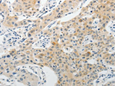 The image on the left is immunohistochemistry of paraffin-embedded Human lung cancer tissue using CSB-PA555877(PADI4 Antibody) at dilution 1/15, on the right is treated with fusion protein. (Original magnification: ×200)