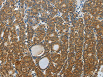 The image on the left is immunohistochemistry of paraffin-embedded Human thyroid cancer tissue using CSB-PA555880(DNAJC3 Antibody) at dilution 1/30, on the right is treated with fusion protein. (Original magnification: ×200)