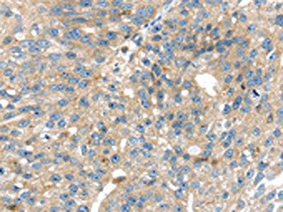 The image on the left is immunohistochemistry of paraffin-embedded Human breast cancer tissue using CSB-PA555966(SIGLEC8 Antibody) at dilution 1/25, on the right is treated with synthetic peptide. (Original magnification: ×200)