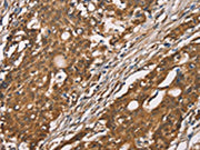 The image on the left is immunohistochemistry of paraffin-embedded Human gastic cancer tissue using CSB-PA556009(DICER1 Antibody) at dilution 1/40, on the right is treated with synthetic peptide. (Original magnification: ×200)