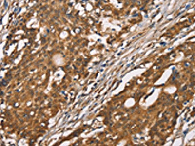 The image on the left is immunohistochemistry of paraffin-embedded Human gastic cancer tissue using CSB-PA556009(DICER1 Antibody) at dilution 1/40, on the right is treated with synthetic peptide. (Original magnification: ×200)