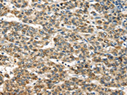 The image on the left is immunohistochemistry of paraffin-embedded Human liver cancer tissue using CSB-PA556193(TNFAIP2 Antibody) at dilution 1/40, on the right is treated with fusion protein. (Original magnification: ×200)